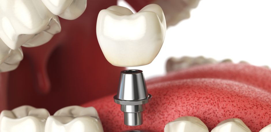 How to Find the Right Oral Surgeon